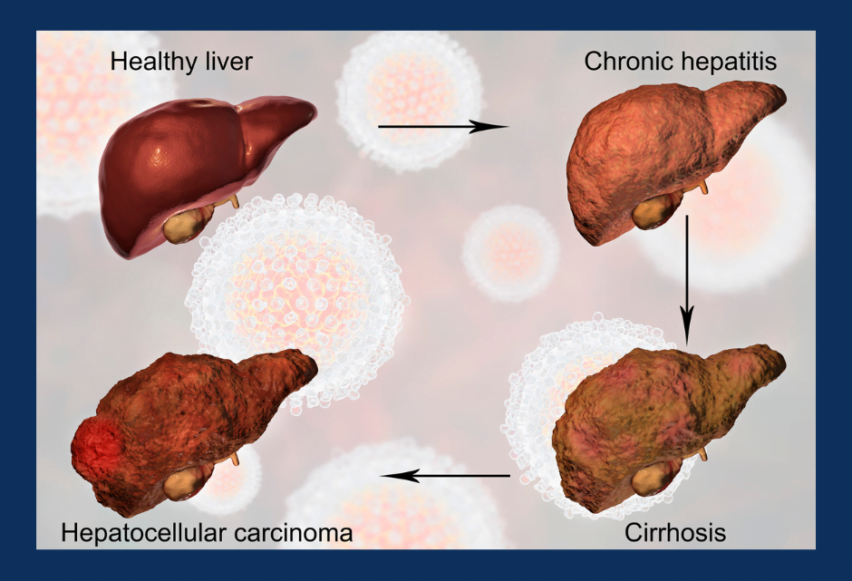 Images of a healthy liver, a liver with chronic hepatitis c, cirrhosis, and hepatocellular carcinoma